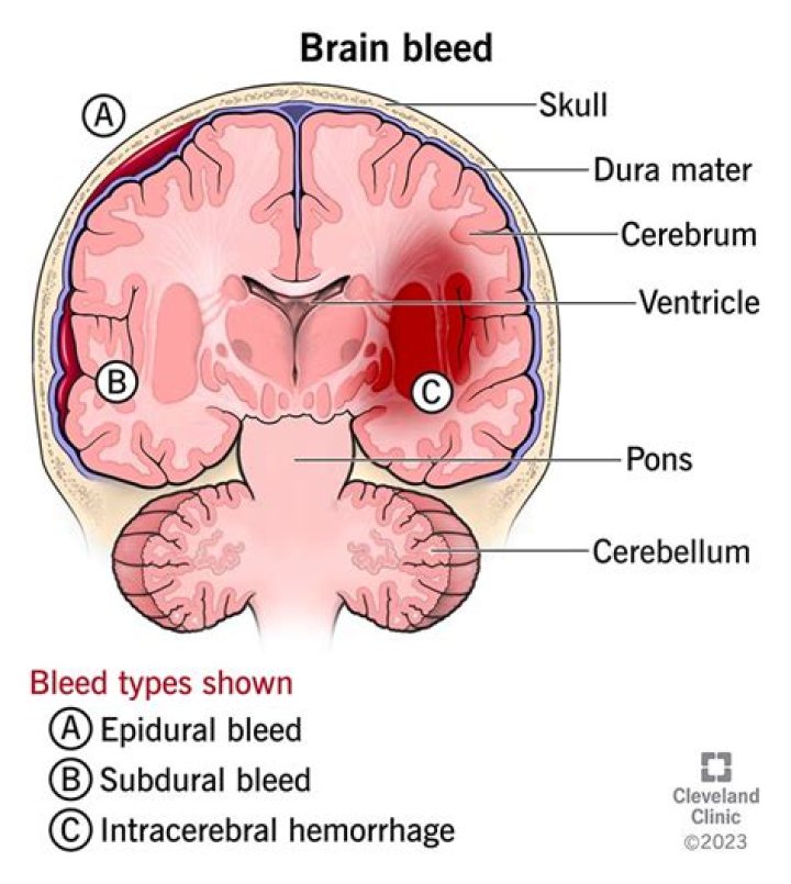 Are brain bleed and stroke the same?