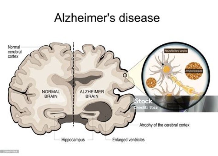Can cerebral amyloid cause seizures?