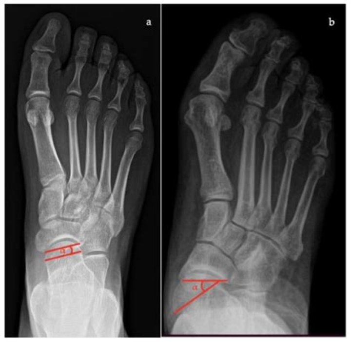 In flatfoot deformity is also known as?