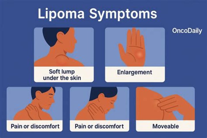 Is lipomas a word?