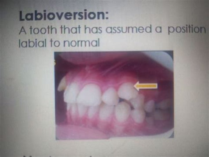 What is dental labioversion?