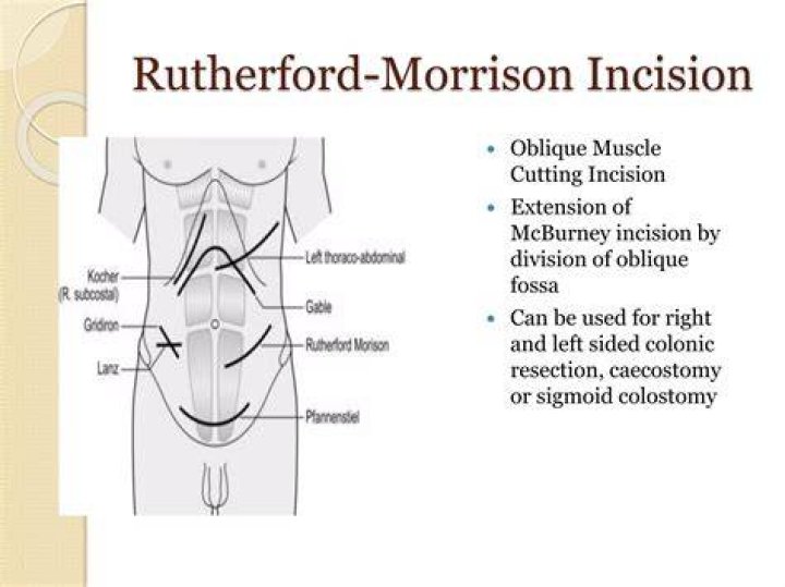 What is rutherford morison incision?