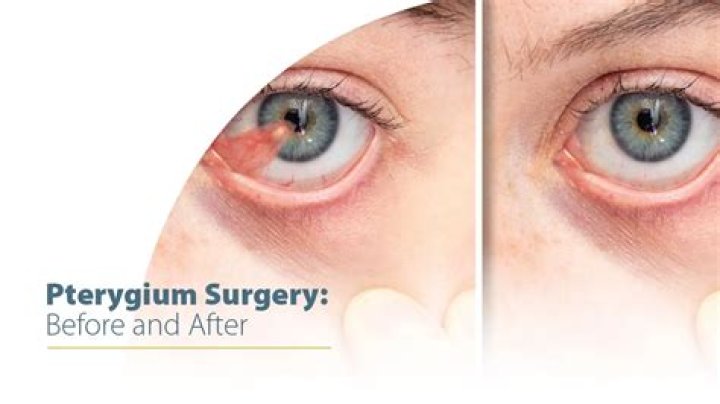 What is the treatment for pterygium?