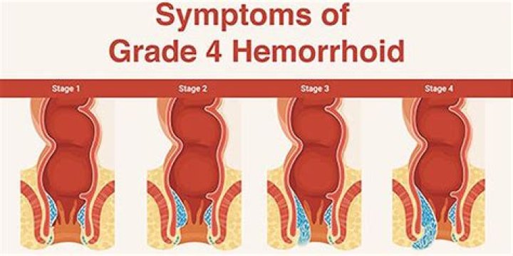 When a hemorrhoid ruptures?