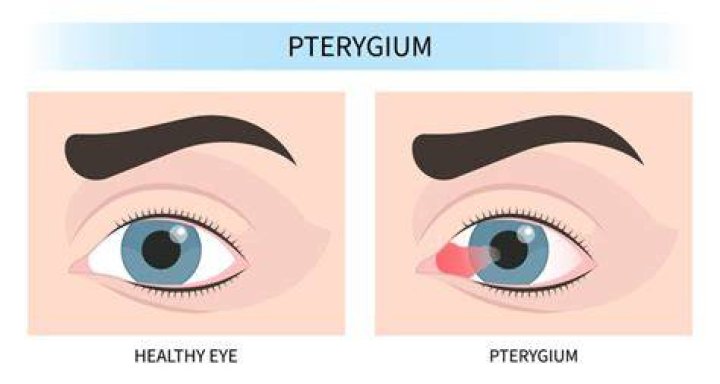 Will pterygium go away?